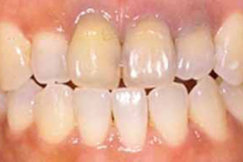 治療前写真:前歯2本が黄ばんでいる状態