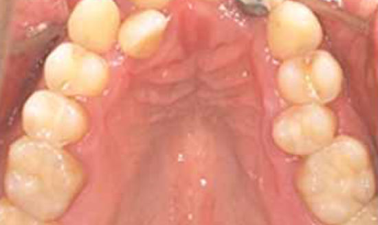 治療後：金属アレルギーの方のセラミック治療