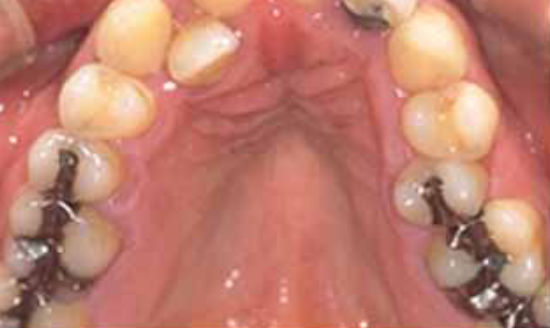 治療前：金属アレルギーの方のセラミック治療