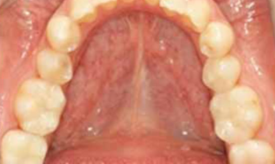 治療後：奥歯のセラミック治療