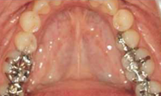 治療前：奥歯のセラミック治療