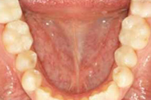 岡山の審美歯科でセラミックインレー治療