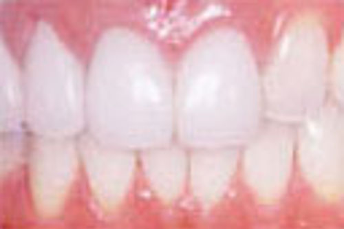 岡山市北区でセラミックティース治療