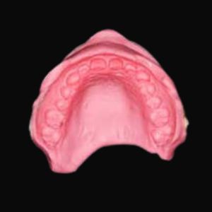 審美歯科治療における歯の型取り