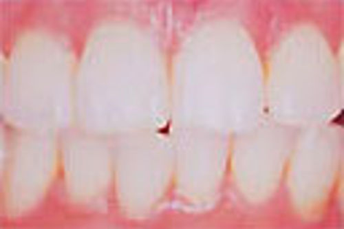 岡山市の歯科医院でハイブリッドセラミック治療