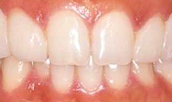 治療後：前歯の歪みを修復