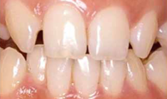 治療前：前歯の歪みを修復