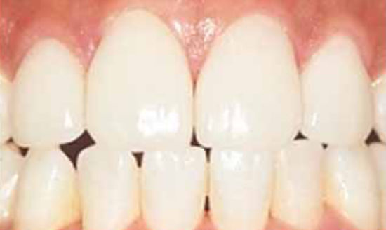 治療後：歯の隙間と変色を審美治療