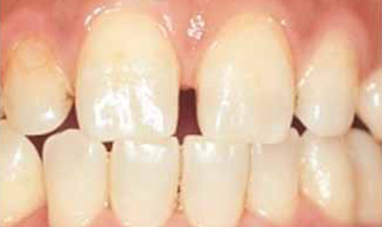 治療前：歯の隙間と変色を審美治療