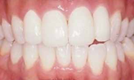 前歯のガタガタをラミネートベニアで治療