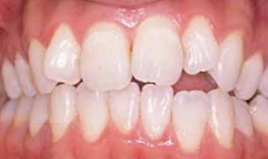 前歯のガタガタをラミネートベニアで治療