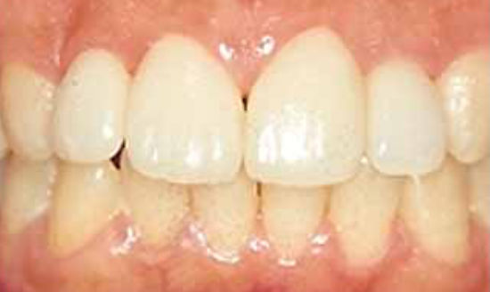 ラミネートベニアによる歯の隙間治療