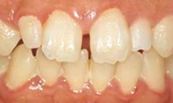ラミネートベニアによる歯の隙間治療