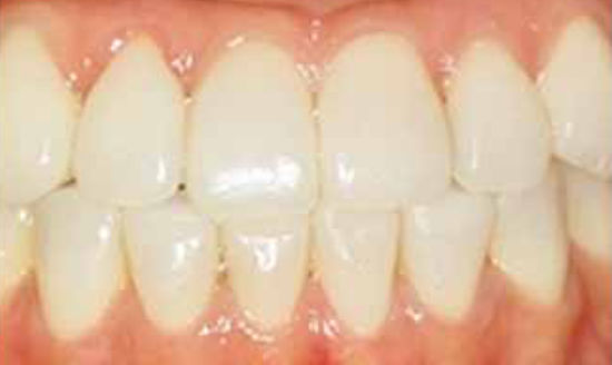 治療後：前歯の隙間と歯の変色