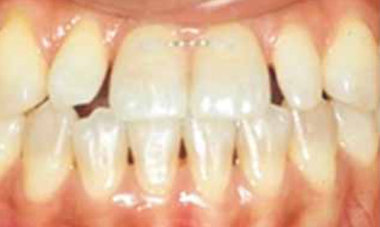 治療前：前歯の隙間と歯の変色