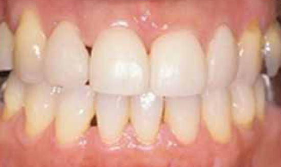 治療後：前歯の隙間にラミネートベニア