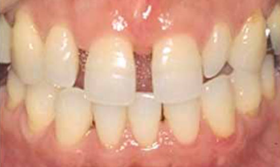 治療前：前歯の隙間にラミネートベニア