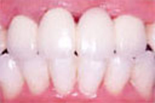 審美歯科「メタルボンド」治療