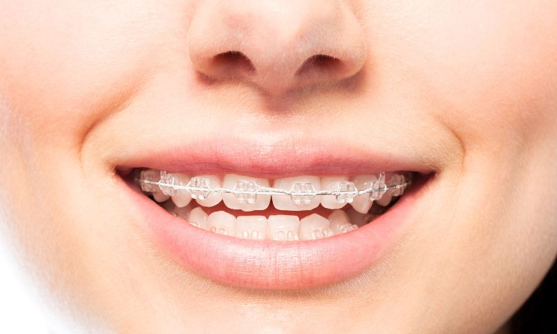 岡山の歯医者で矯正歯科治療