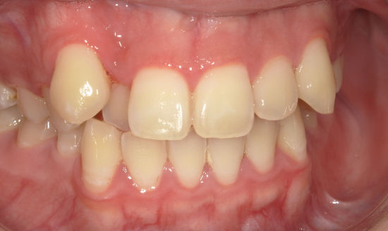 治療後：歯の表面の白濁をアイコン治療