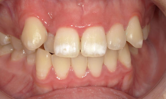 治療前：歯の表面の白濁をアイコン治療