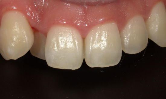 治療後：歯の表面の白濁をアイコン治療（上の歯の拡大写真）
