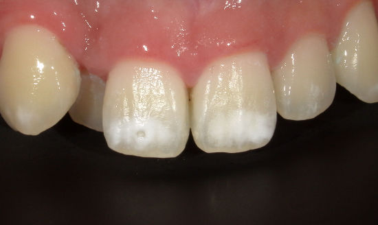 治療前：歯の表面の白濁をアイコン治療（上の歯の拡大写真）