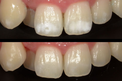 岡山で歯の表面の白い斑点をホワイトスポット治療