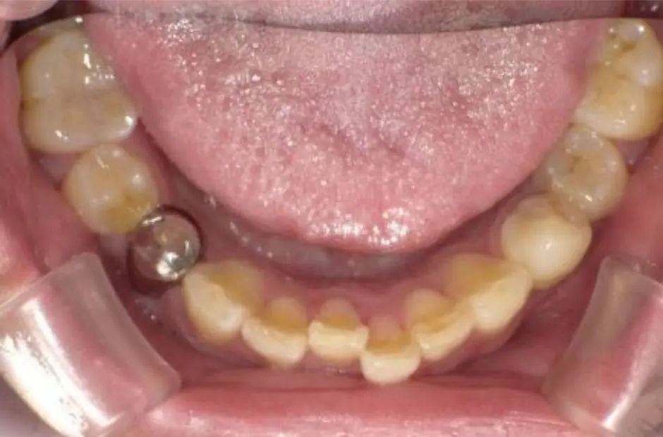 金属アレルギー治療の症例・治療前写真（銀歯1本）