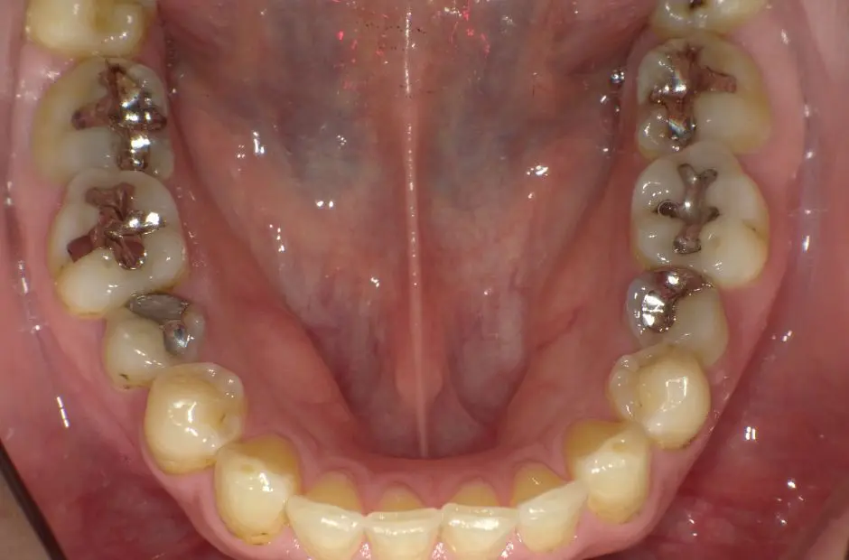 金属アレルギー治療の症例・治療前写真（銀歯7本）