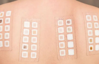 岡山の皮膚科で行うパッチテスト