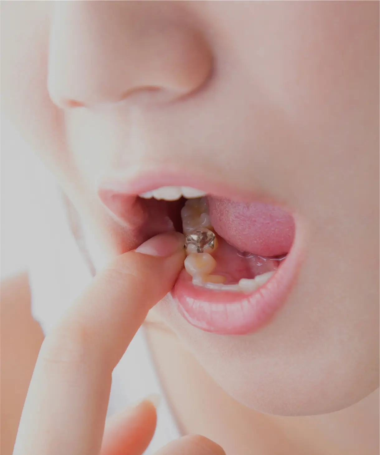 過去の歯科治療で金属の詰め物を入れた記憶はありますか？